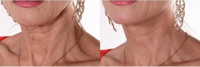 Beauty-čudno: zakaj ženske lepilo trak na vratu